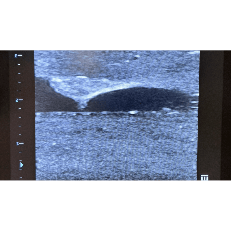 Femoral Access Ultrasound Simulator with Calcifications