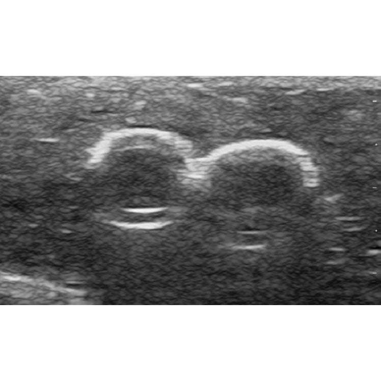 Femoral Artery Puncture Training Model