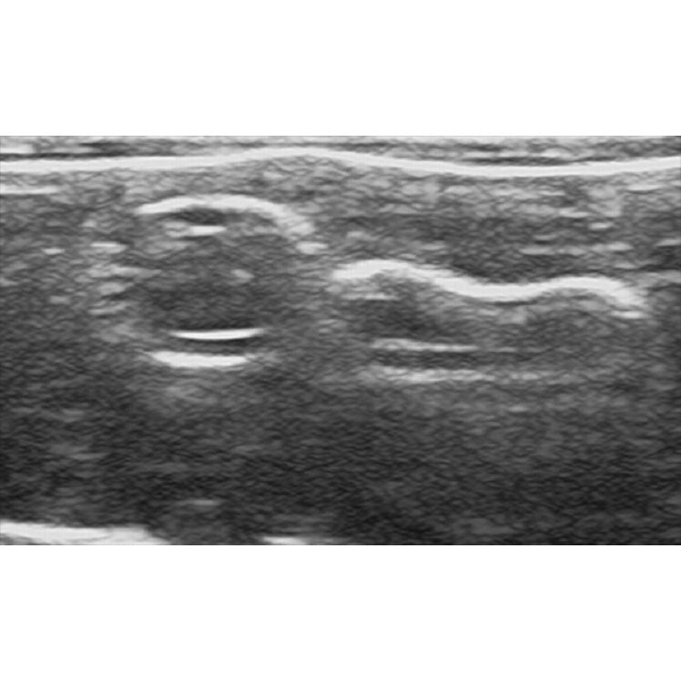 Femoral Artery Puncture Training Model