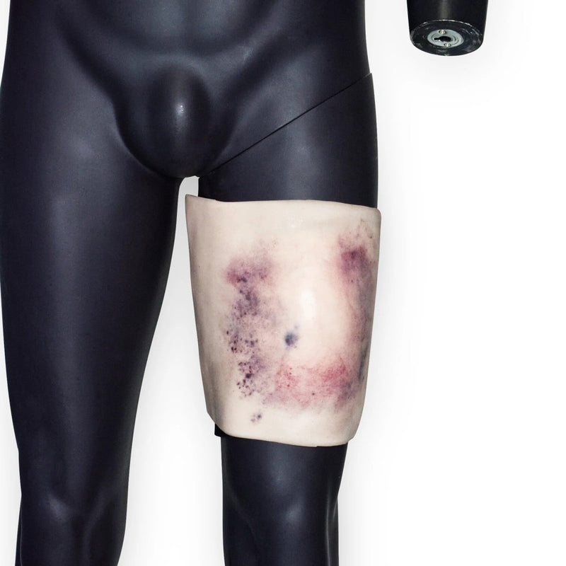 Femur Fracture Closed