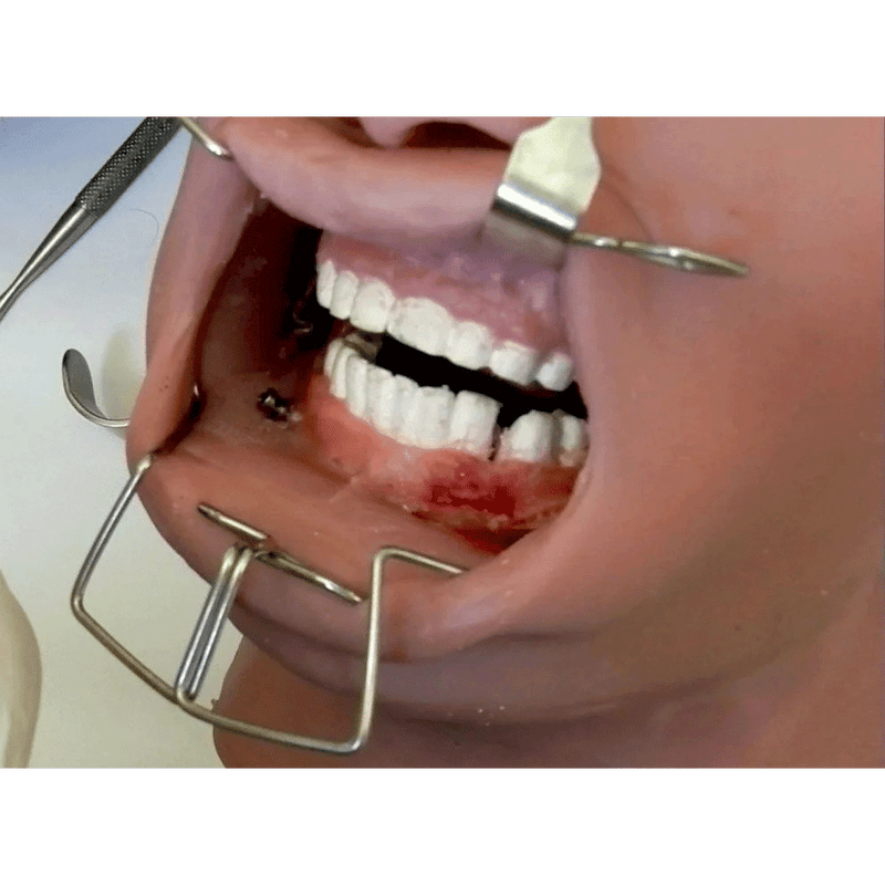Oral and Maxillo Facial Surgery Simulator with Optional Fractures