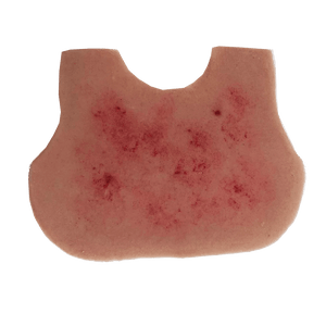 Meningitis Rash