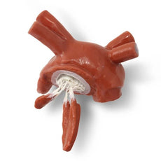 MICS Left Atrium with Prolapsed Mitral Valve, Chordae and Papillaries