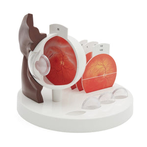 Pathological Eye Model, 5x Life-size, Dark Skin