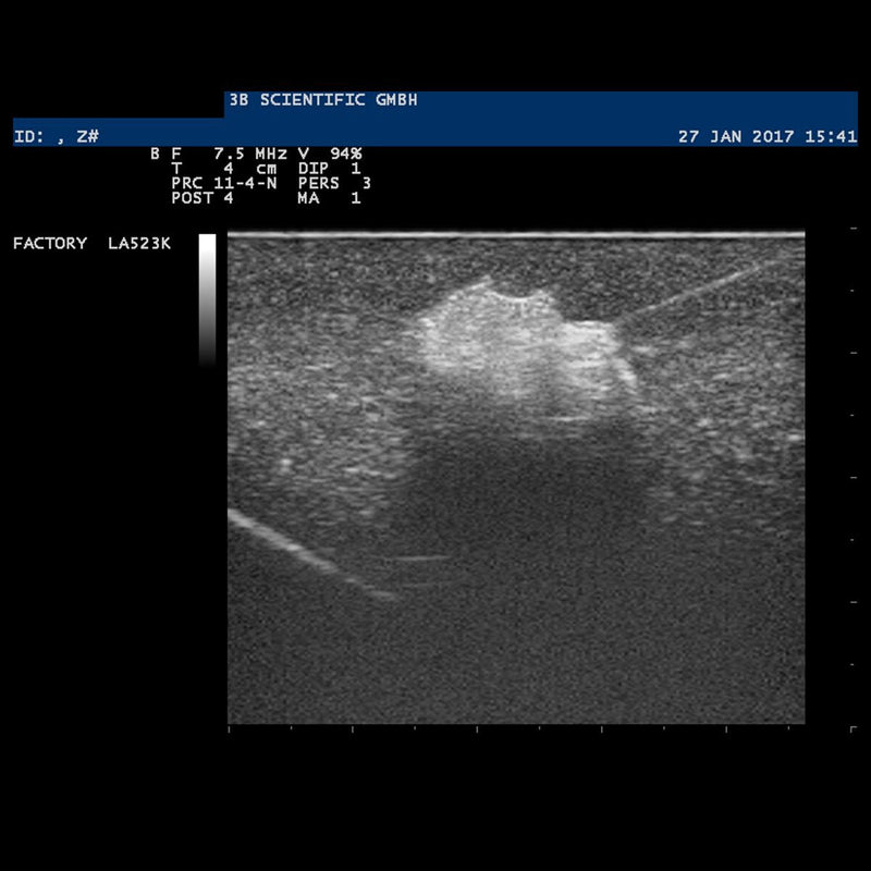 SONOtrain™ Ultrasound Breast Model With Cysts, Dark Skin