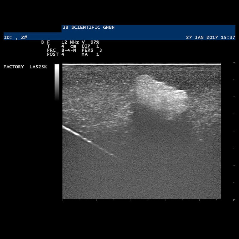 SONOtrain™ Ultrasound Breast Model With Cysts, Dark Skin