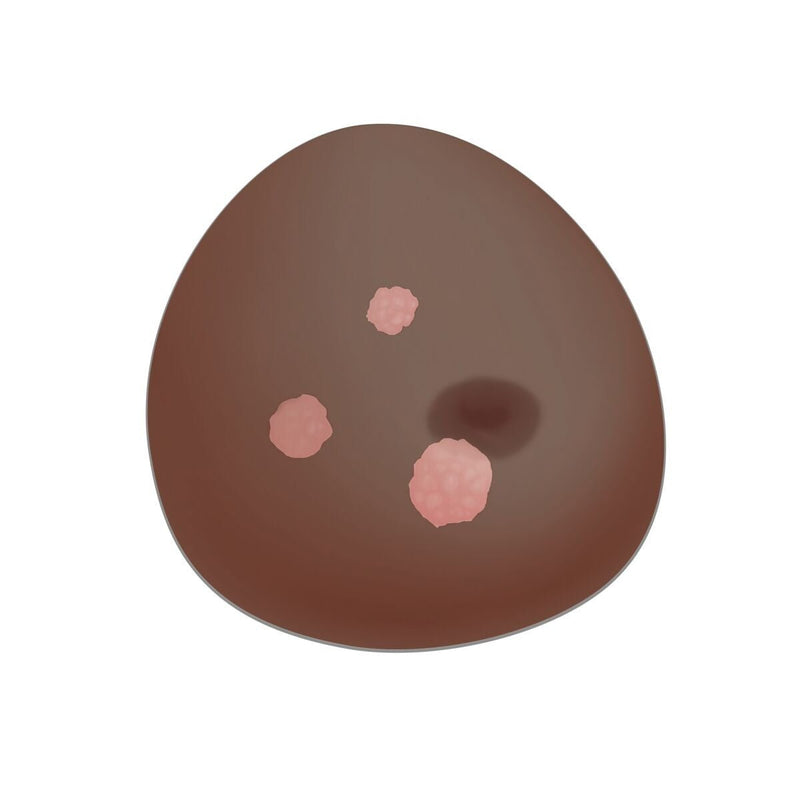 SONOtrain™ Ultrasound Breast with Tumors, Dark Skin
