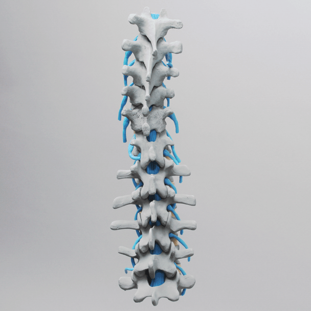Spine, Lumbar, Osteoporotic Vertebrae with Nerve Roots, Radiopaque