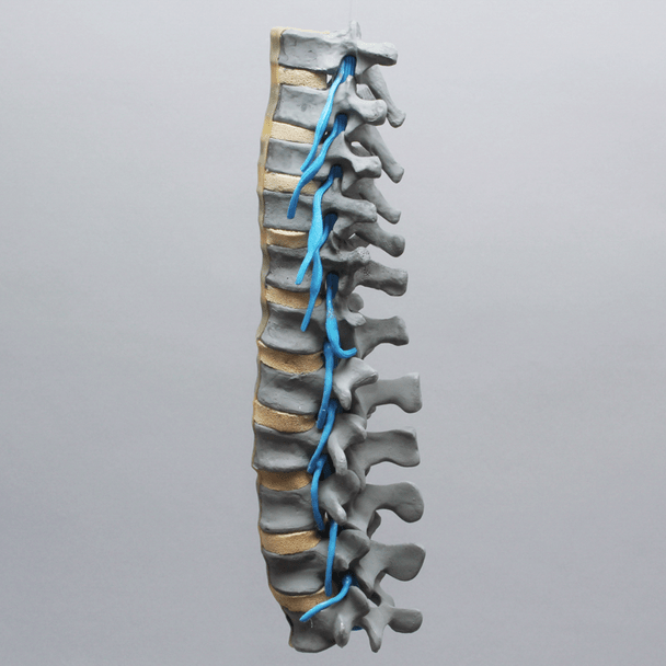 Spine, Lumbar, Osteoporotic Vertebrae with Nerve Roots, Radiopaque