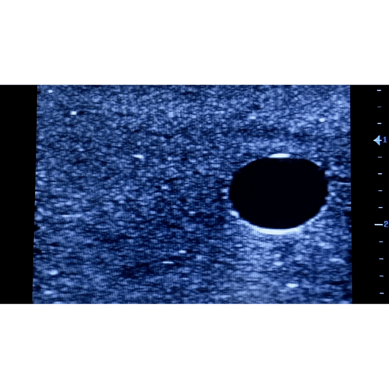 Ultrasound Simulator for Seldinger Technique