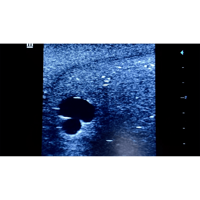 Ultrasound Simulator with 2 Branched Veins