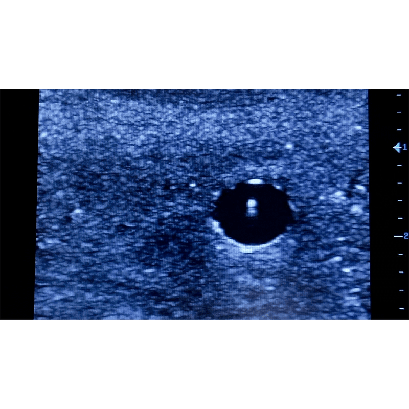 Ultrasound Simulator with 2 Branched Veins