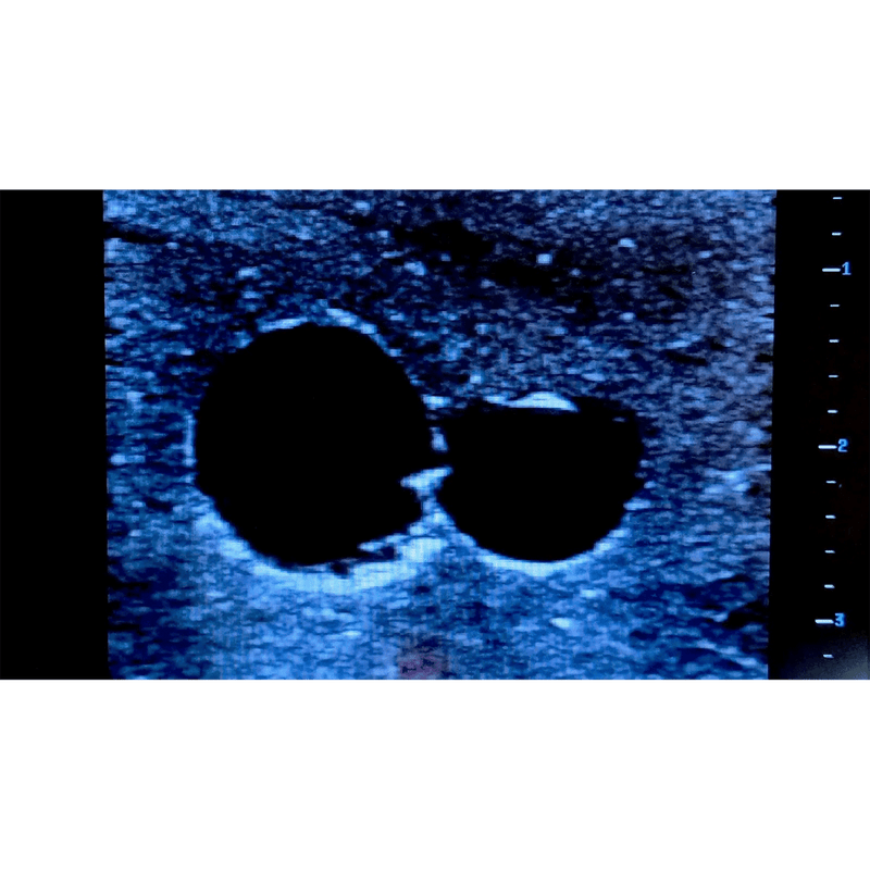 Ultrasound Simulator with 2 Peripheral Veins