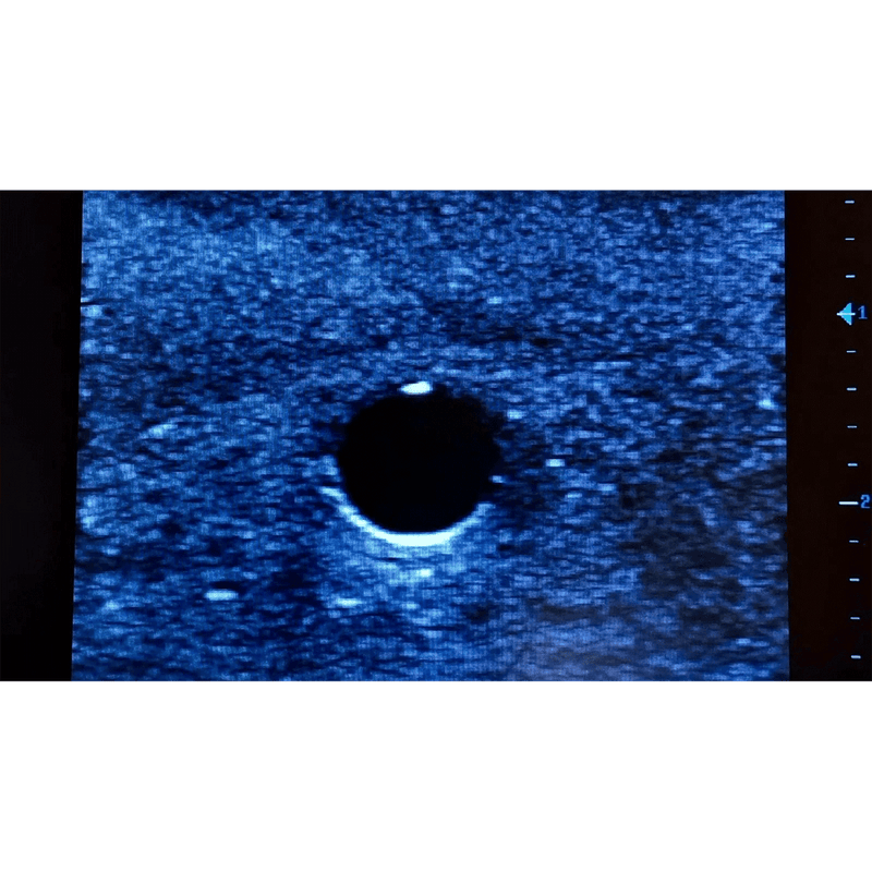 Ultrasound Simulator with 2 Peripheral Veins