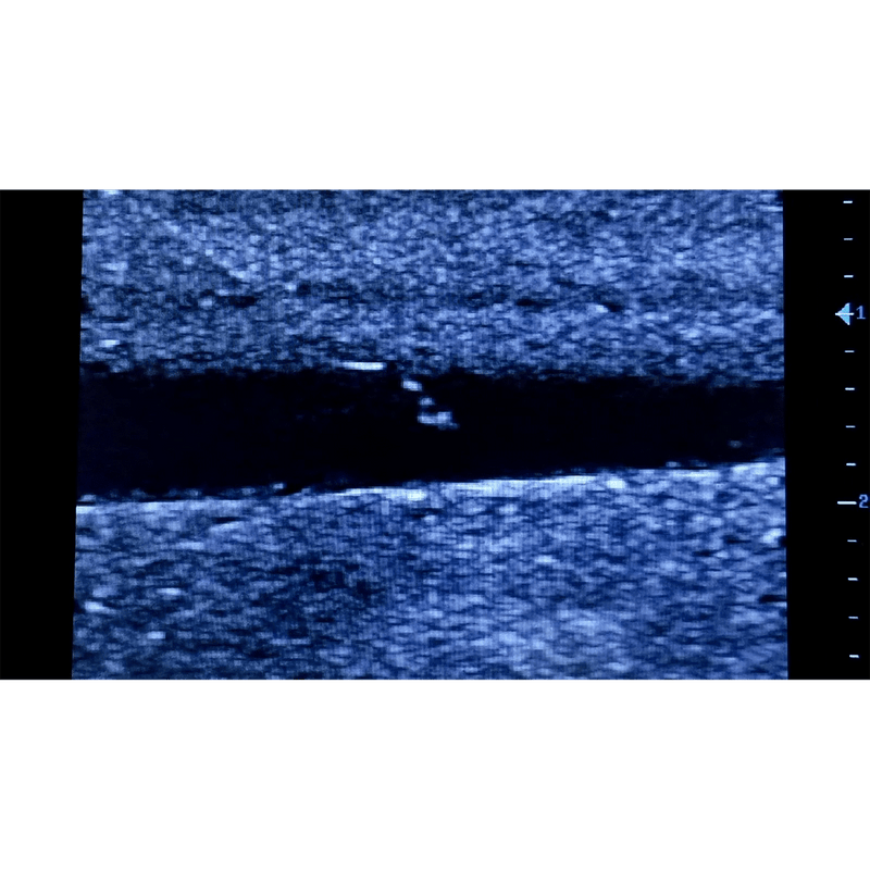 Ultrasound Simulator with 2 Peripheral Veins