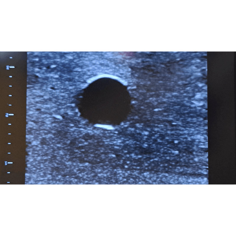 Ultrasound Simulator with 2 Peripheral Veins