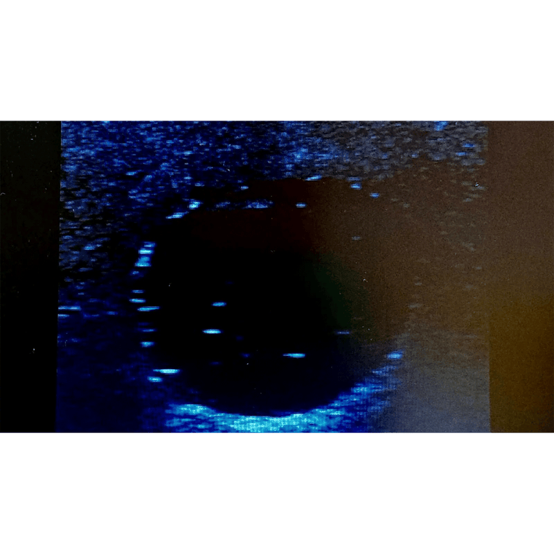 Ultrasound Simulator with Breast Pathologies/Biopsy