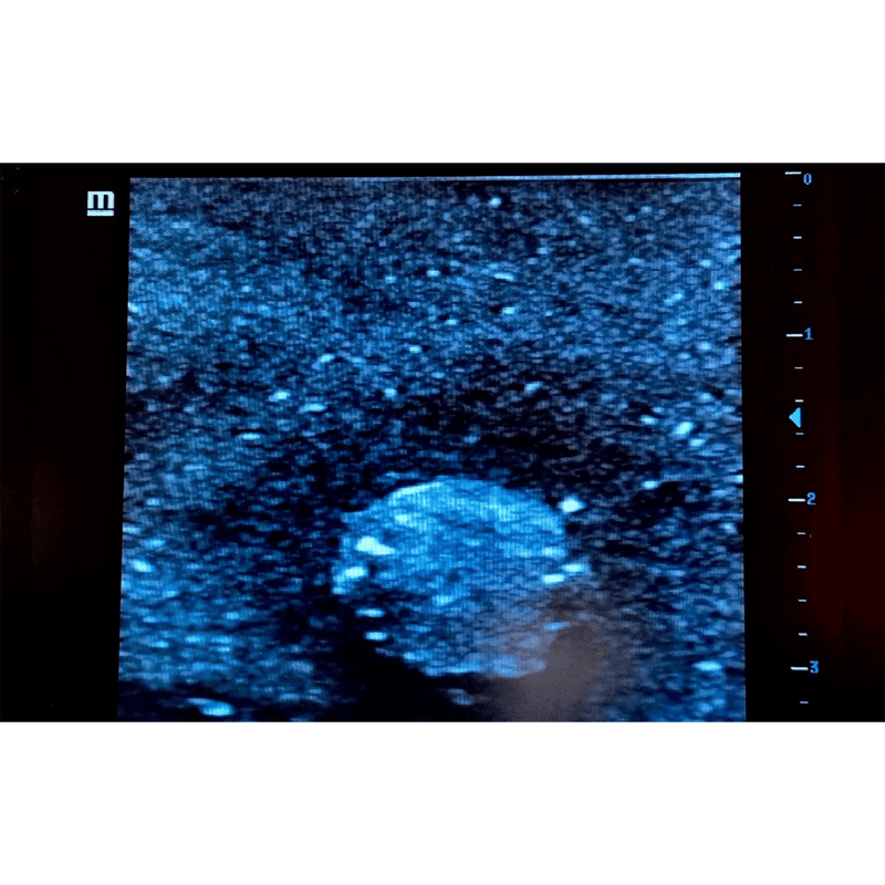 Ultrasound Simulator with Breast Pathologies/Biopsy