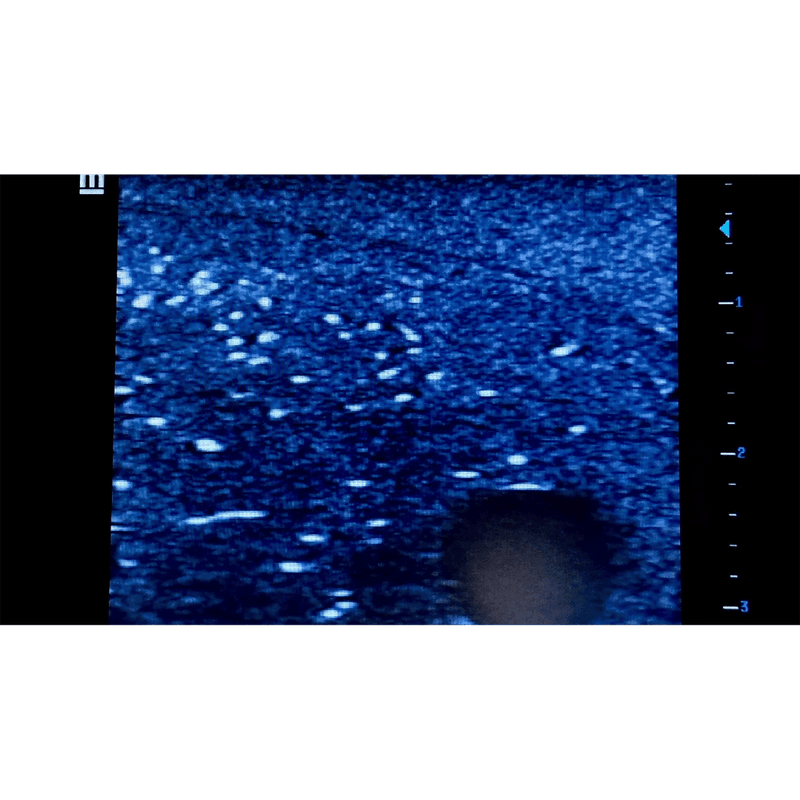 Ultrasound Simulator with Breast Pathologies/Biopsy