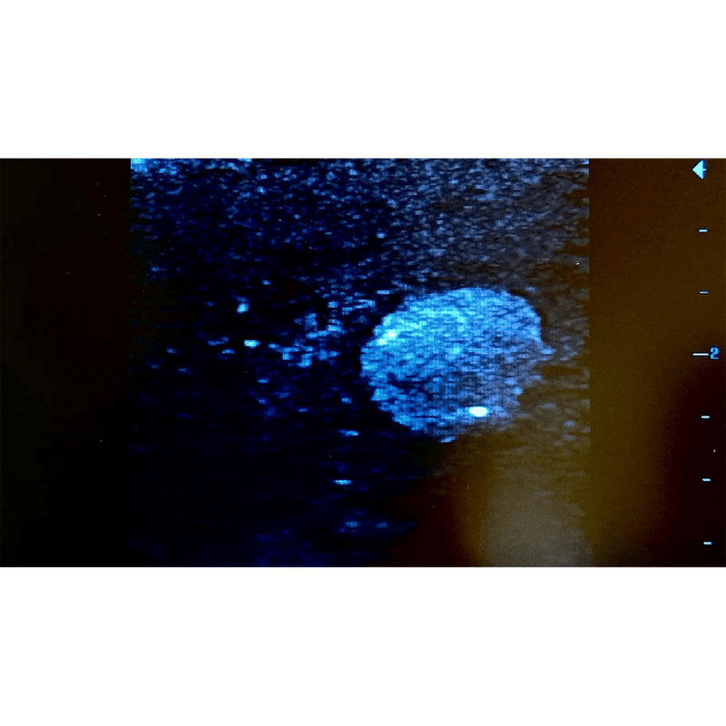 Ultrasound Simulator with Breast Pathologies/Biopsy