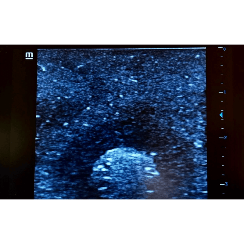 Ultrasound Simulator with Breast Pathologies/Biopsy