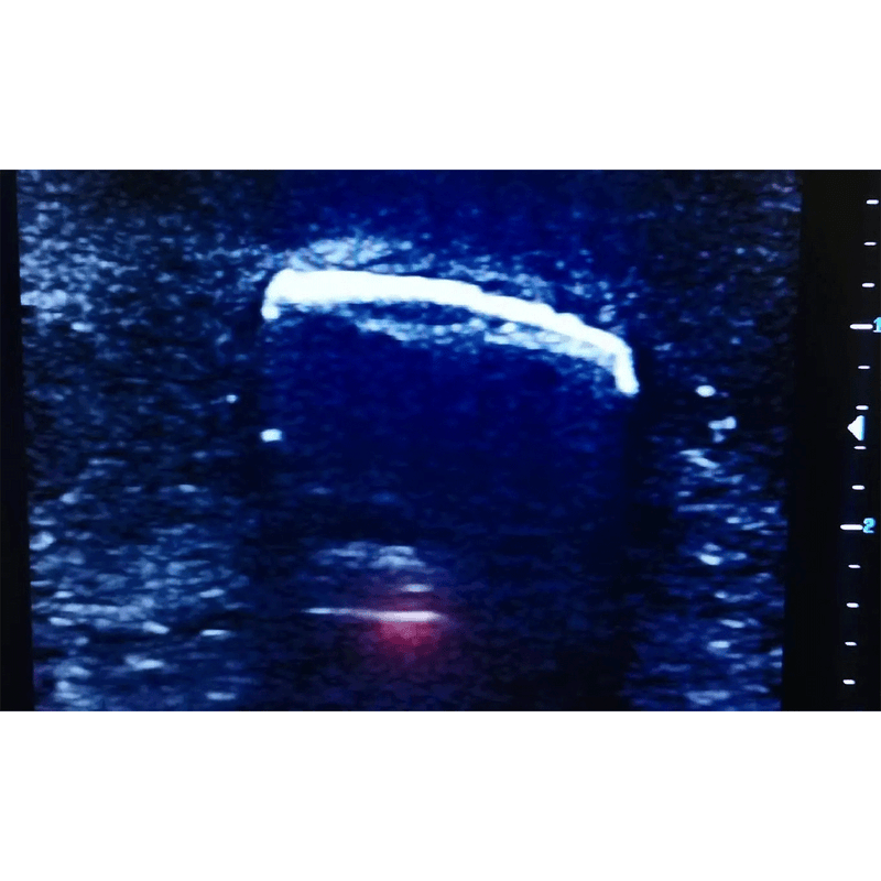 Ultrasound Simulator with Foreign Bodies