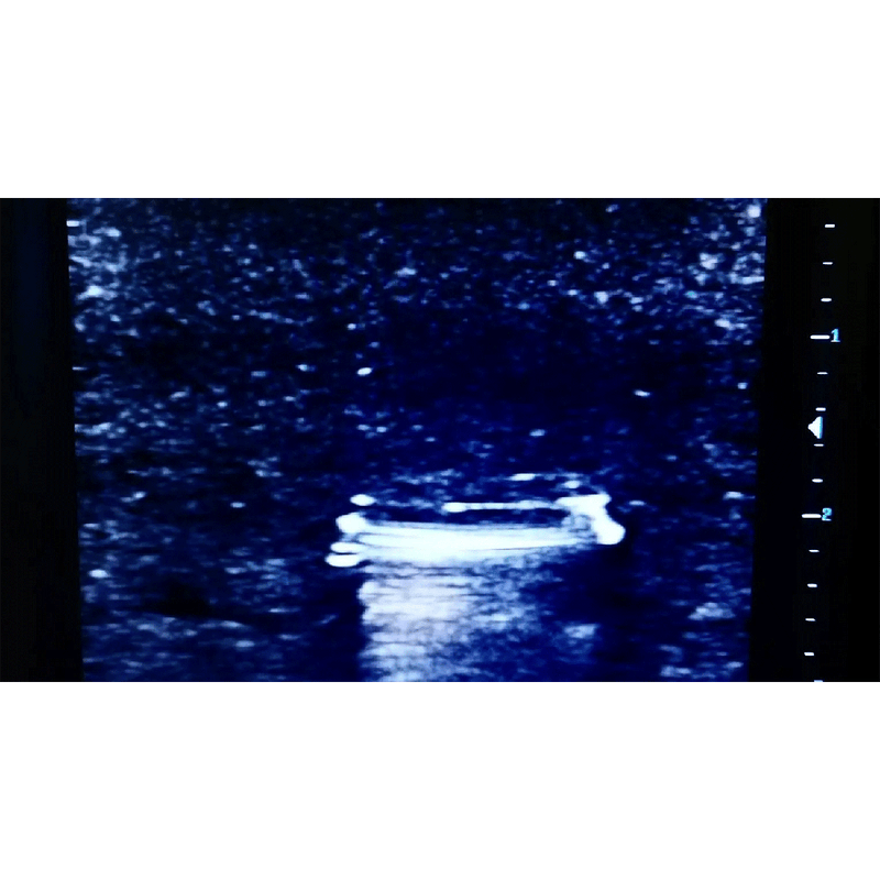 Ultrasound Simulator with Foreign Bodies