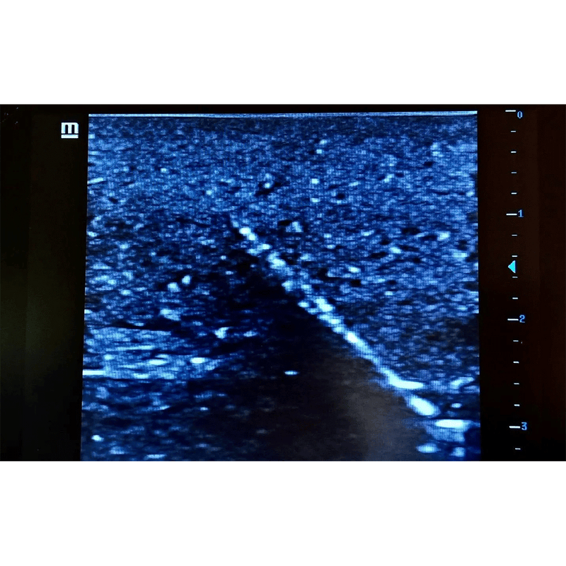 Ultrasound Simulator with Foreign Bodies
