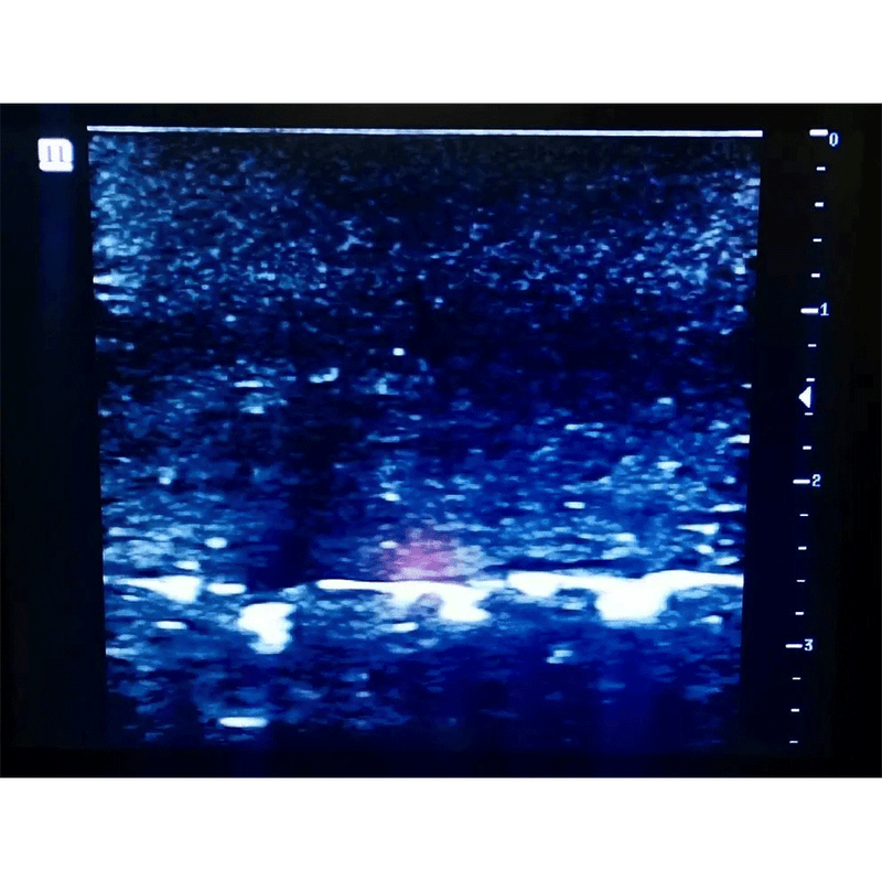 Ultrasound Simulator with Foreign Bodies