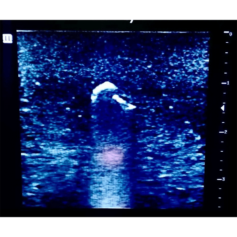 Ultrasound Simulator with Foreign Bodies