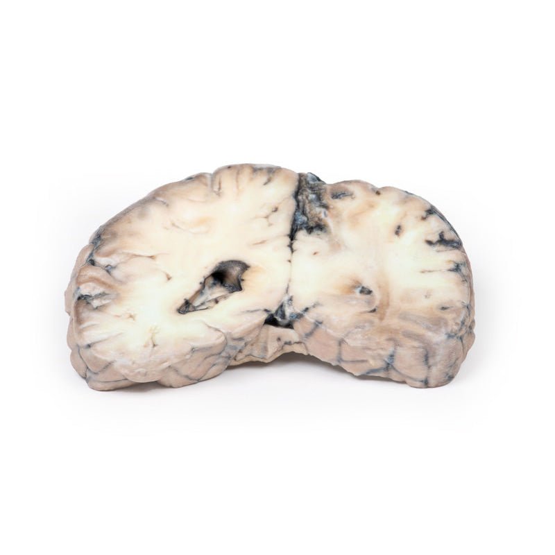 3D Printed Cerebral Arterio-Venous Malformation