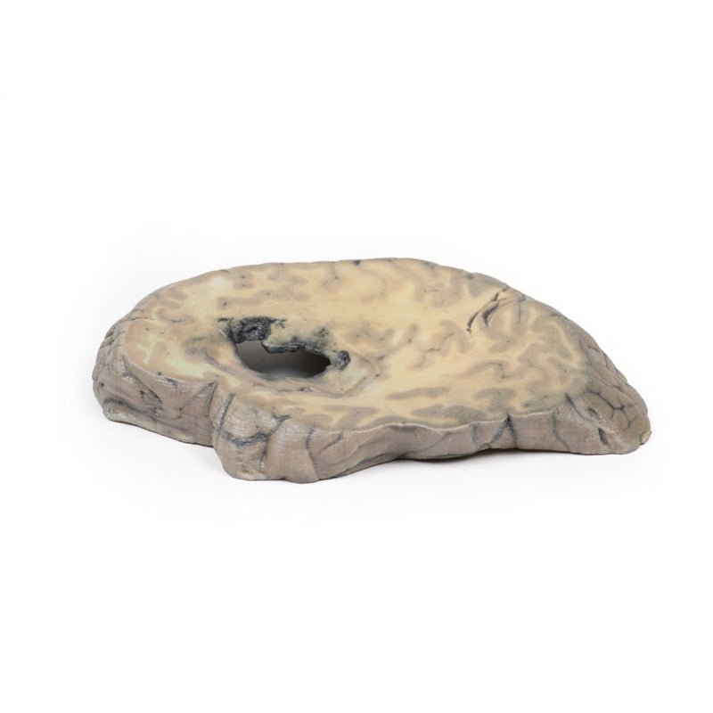 3D Printed Cerebral Haemorrhage