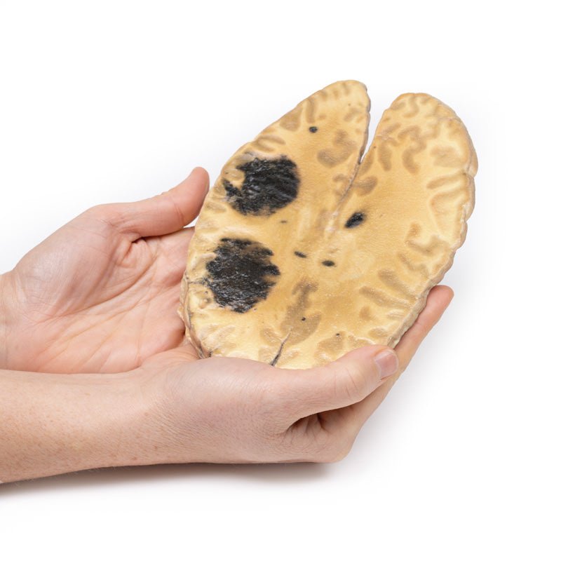 3D Printed Cerebral Haemorrhage, Secondary to Acute Myeloid Leukaemia