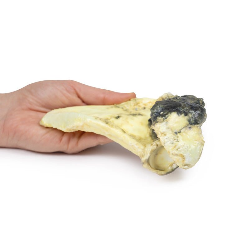 3D Printed Chondrosarcoma of Scapula