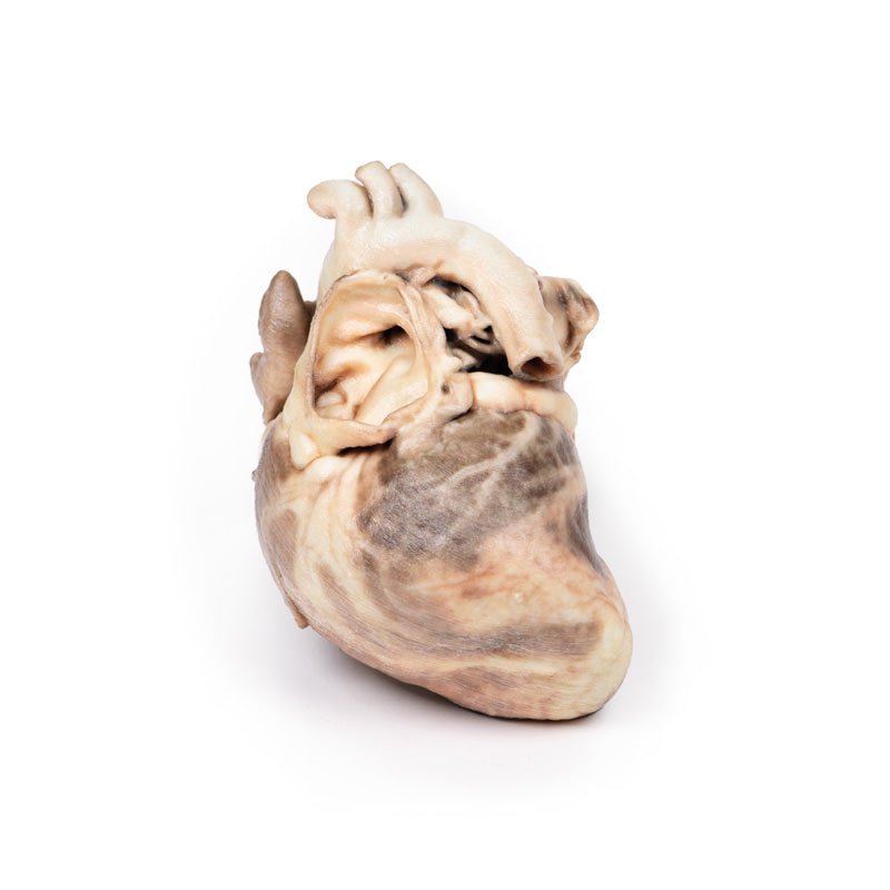 3D Printed Congenital Pulmonary Stenosis