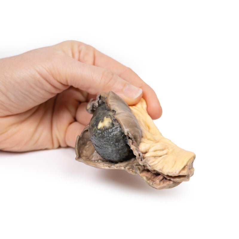 3D Printed Gall Stone Ileus