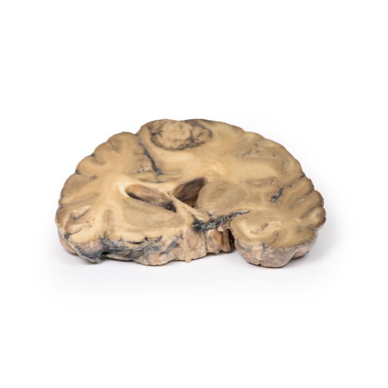 3D Printed Metastatic Adenocarcinoma in the Brain