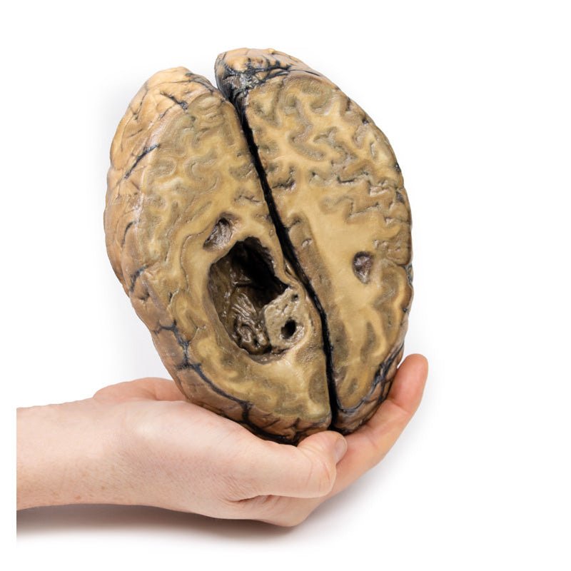 3D Printed Metastatic Carcinoma in the Brain