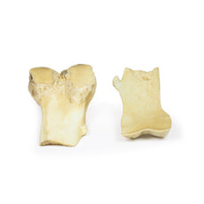 3D Printed Osteochondroma