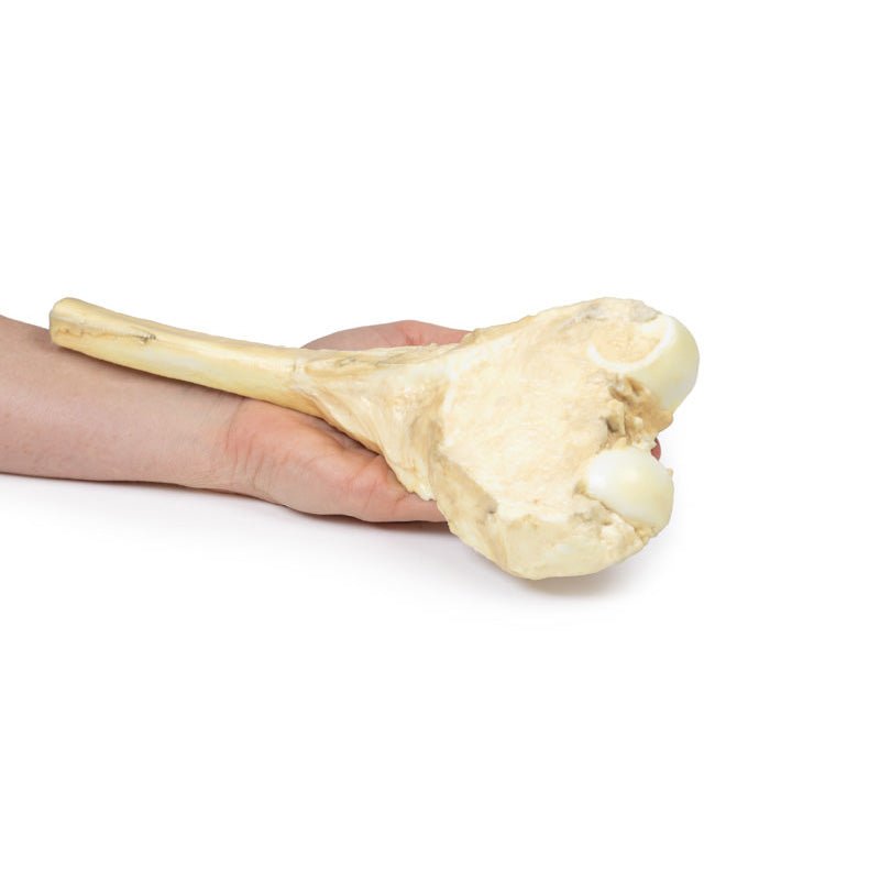 3D Printed Osteosarcoma of Femur