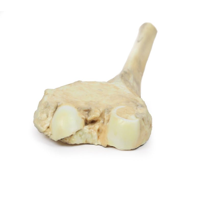 3D Printed Osteosarcoma of Femur