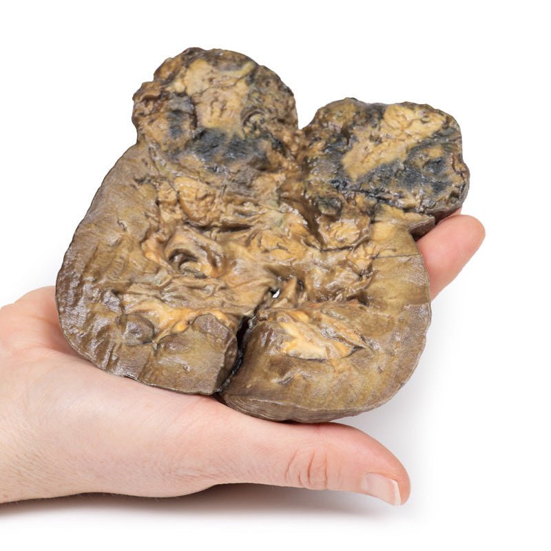 3D Printed Renal Cell Carcinoma