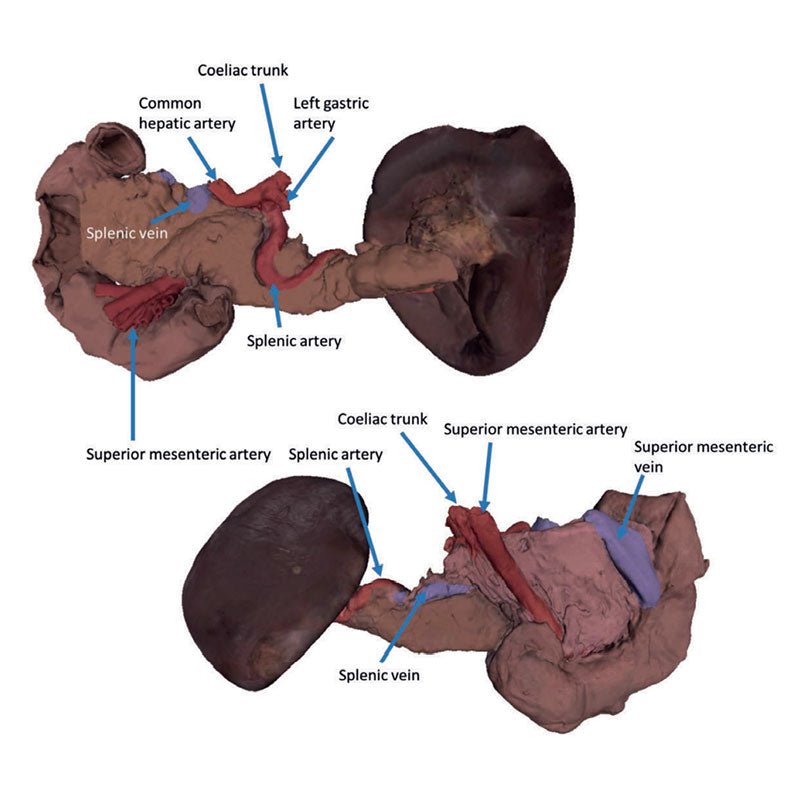 3D Printed Spleen and Pancreas