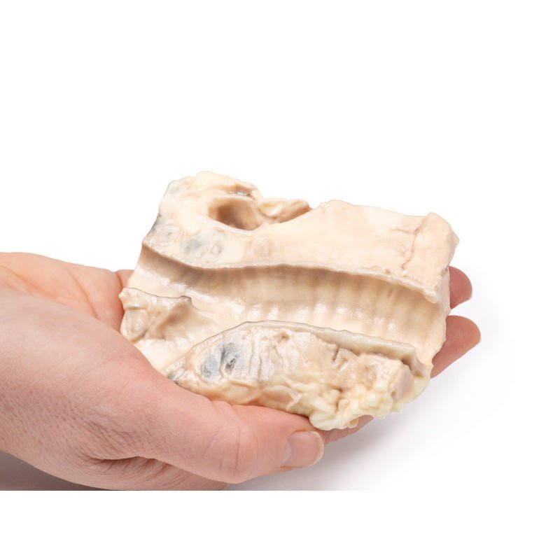 3D Printed Trachea - Hodgkin Lymphoma