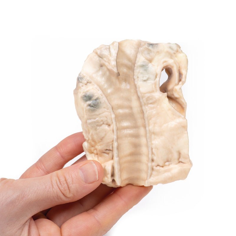 3D Printed Trachea - Hodgkin Lymphoma