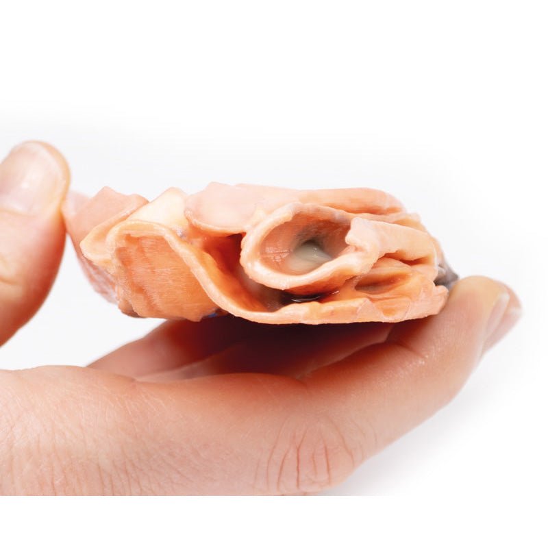 3D Printed Traumatic Oesophageal-aortic Fistula