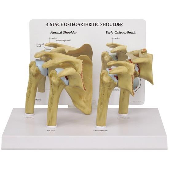 Acromioclavicular Joint Osteoarthritis Orlando, FL