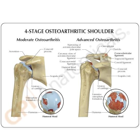 4-Stage Osteoarthritis (OA) Shoulder