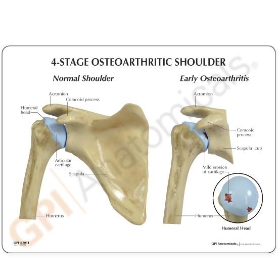 4-Stage Osteoarthritis (OA) Shoulder