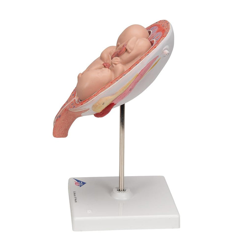 5th Month Twin Fetuses - Normal Position